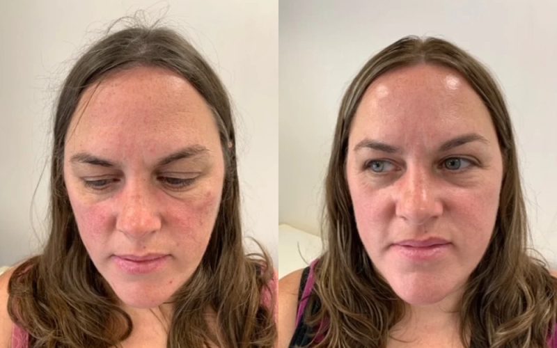 Acne-Before-And-After4