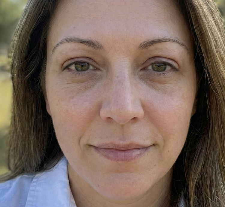 After Eyelid Surgery - Upper Blepharoplasty 2