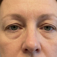 Before Eyelid Surgery - Upper Blepharoplasty 1