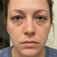 Before Eyelid Surgery - Upper Blepharoplasty 2