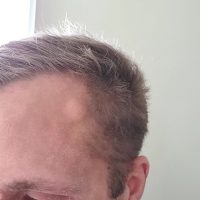 Before Forehead Cyst Removal