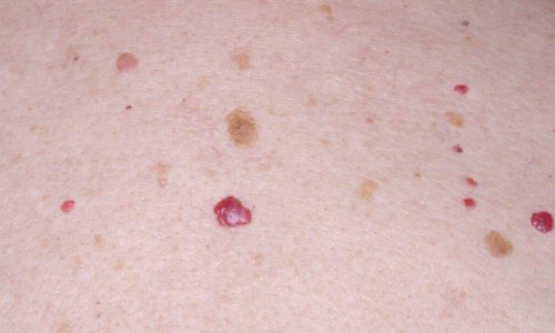 Cherry Angioma