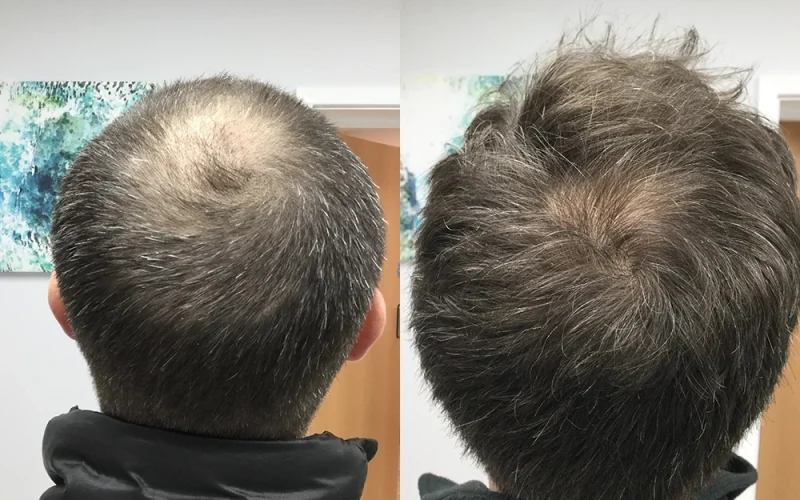 Crown-Hair-Transplant-Before-And-After-1-1
