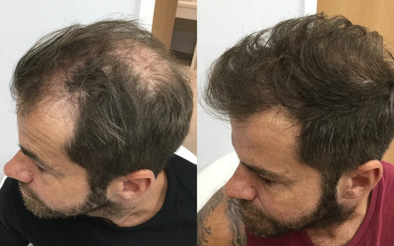 Crown Hair Transplant Before And After