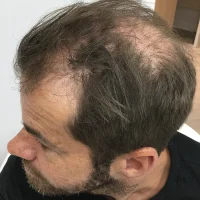 Crown Hair Transplant Before And After