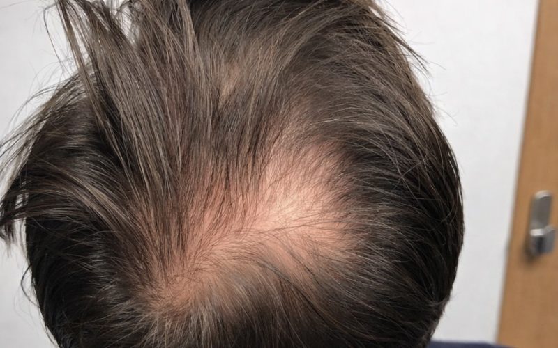 Crown Hair Transplant