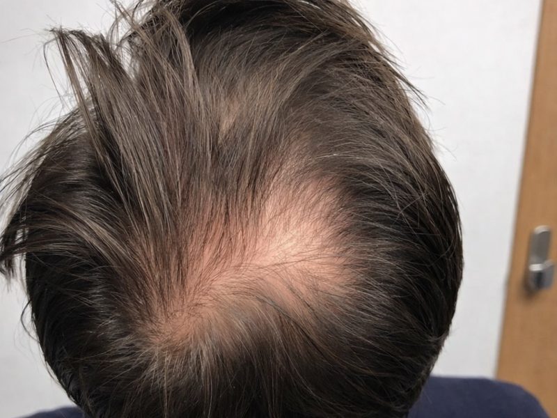 Crown Hair Transplant
