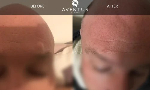 Cyst Before And After 3