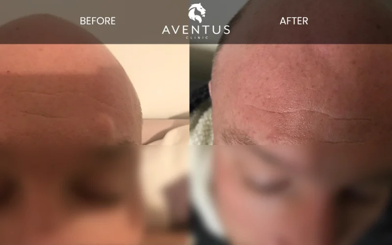 Cyst-Before-And-After-3-1