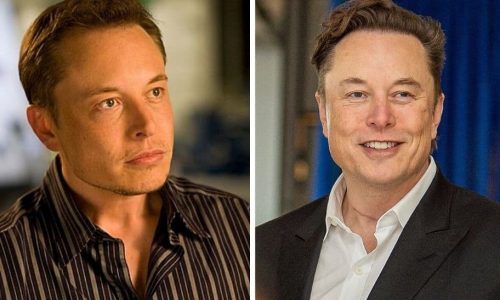 Elon Musk Hair Transplant