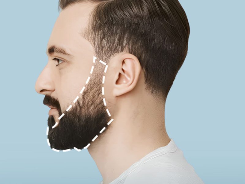 FUE Beard Transplant