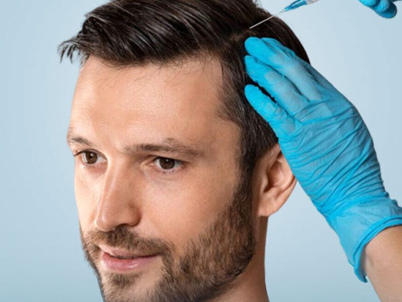 FUE-Hair-Transplant for men