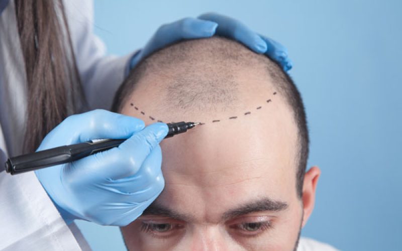 FUE-Hair-Transplants.jpg