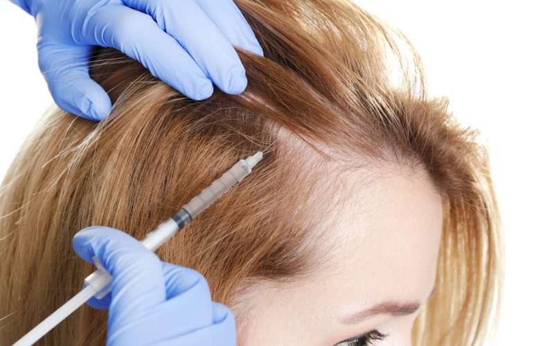 Female Celebrities Who Have Had Hair Transplants