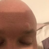 Forehead Cyst before removal