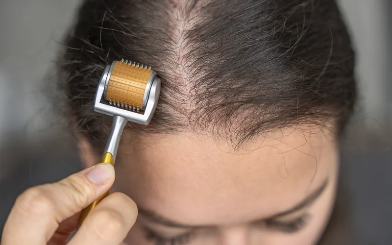 Hair Loss Derma Roller