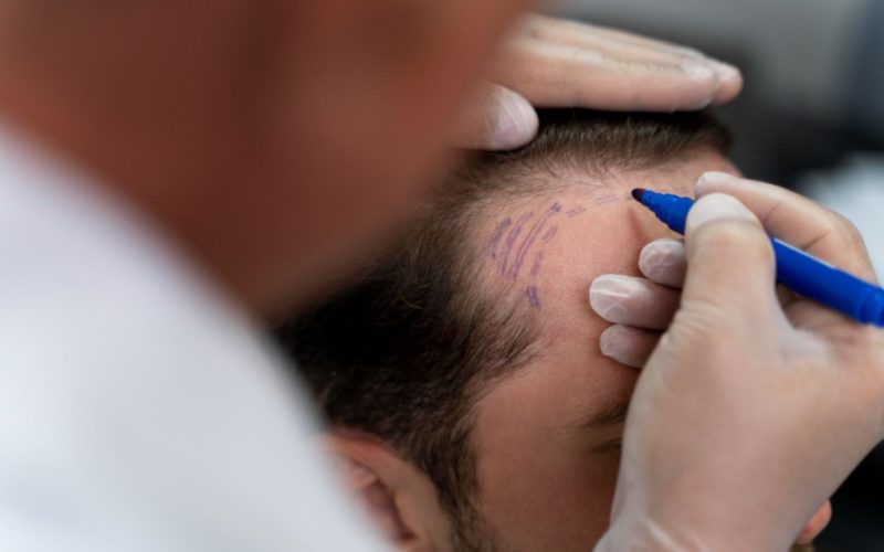 Hair transplant for thick hair