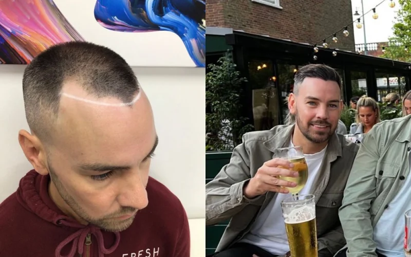 Hairline-Transplant-Before-And-After