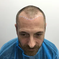 Hairline-Transplant-Journey-3