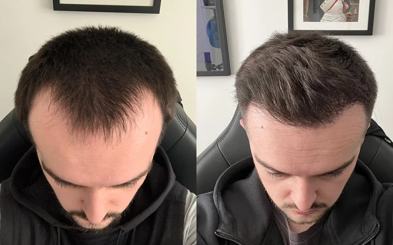 Hairline-transplant-before-and-after-1