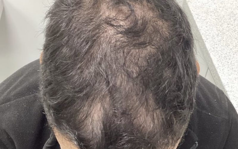 before non surgical hair treatment