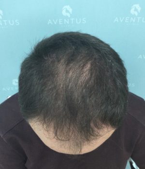 after non surgical hair treatment 3