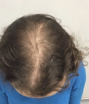 before non surgical hair treatment 4