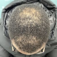 before non surgical hair treatment 5