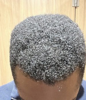 after non surgical hair treatment 5