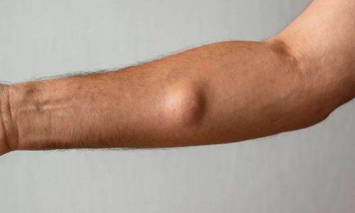 Lump on arms