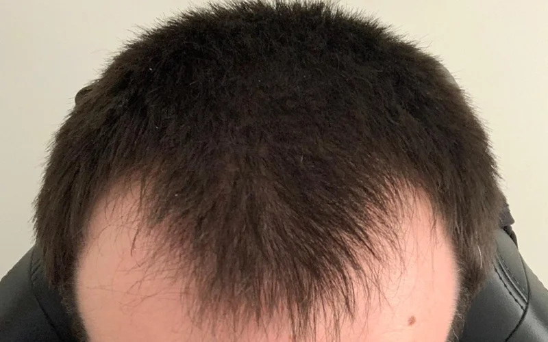 Photo of a man with a m shaped hairline