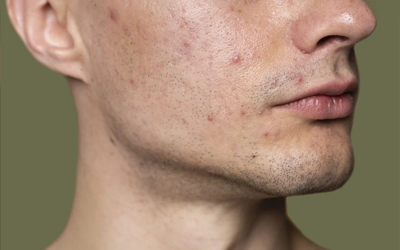 Male Jawline Acne