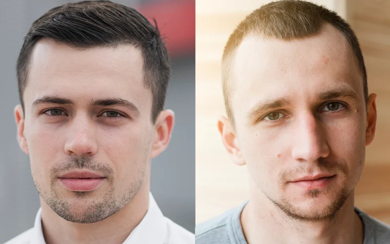 Mature Hairline Vs Receding Hairline