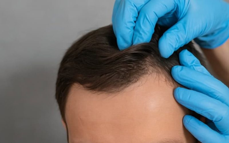 Mature-or-Receding-Hairline