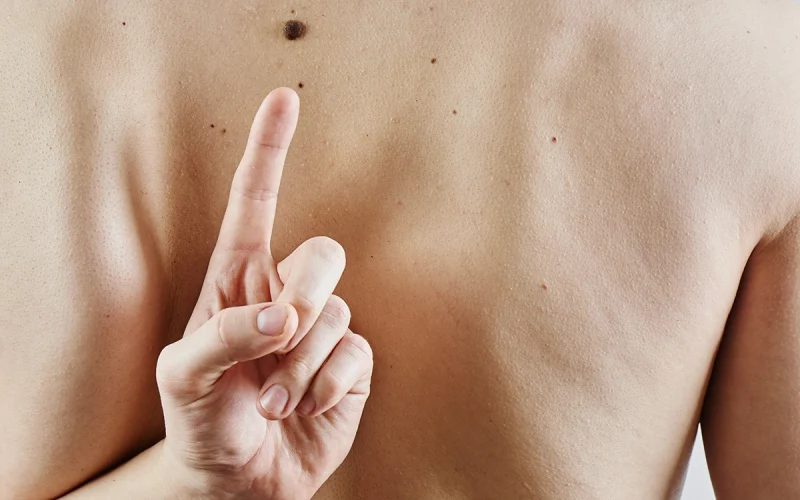 Mole Removal Aftercare