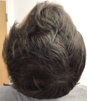 Non-Surgical Hair Treatment After 4