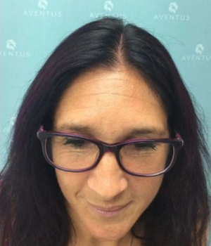 Non-Surgical Hair Treatment After 6