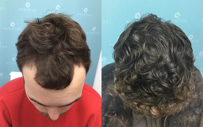 Non Surgical Hair Treatment Before And After2
