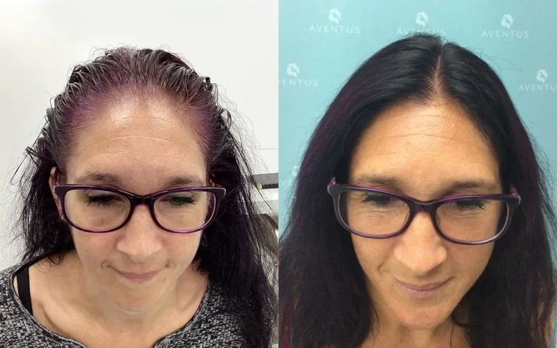 Non Surgical Hair Treatment Before And After3