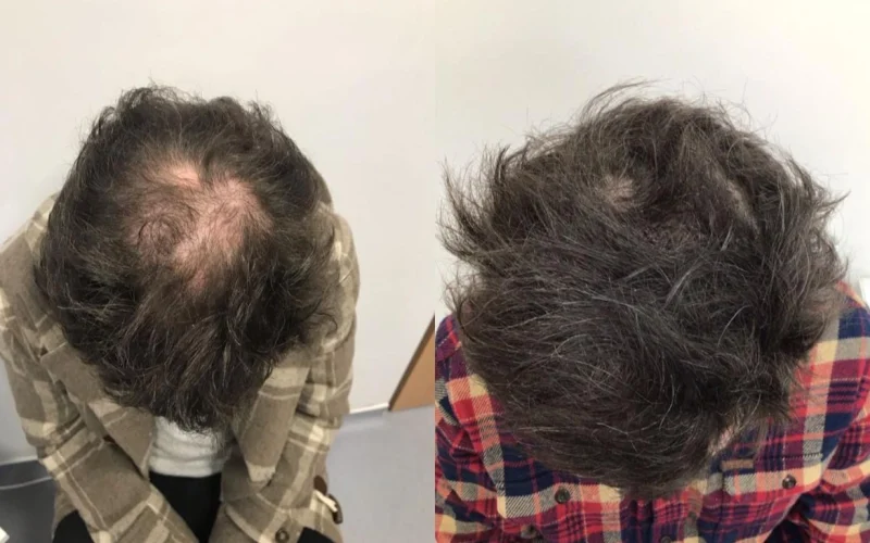 Non Surgical Hair Treatment Before And After4