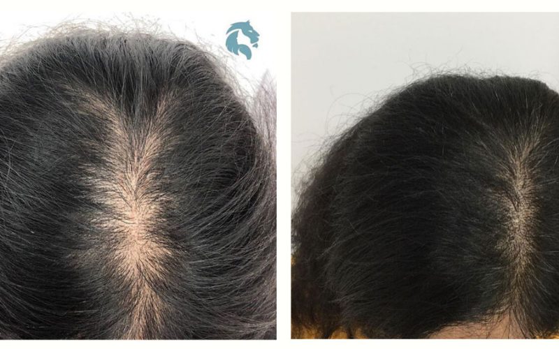 PRP-Injection-for-Hair-Loss-Before-and-After