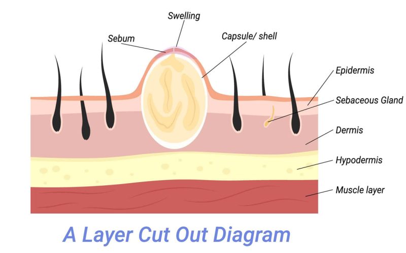 Popping-a-Sebaceous-Cyst