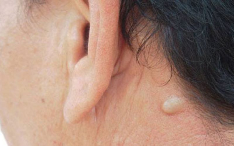 Premier-dermatology-partners-what-are-sebaceous-cysts-how-to-treat