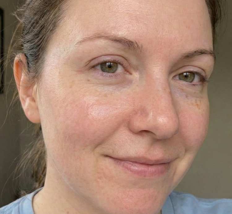 Rosacea after