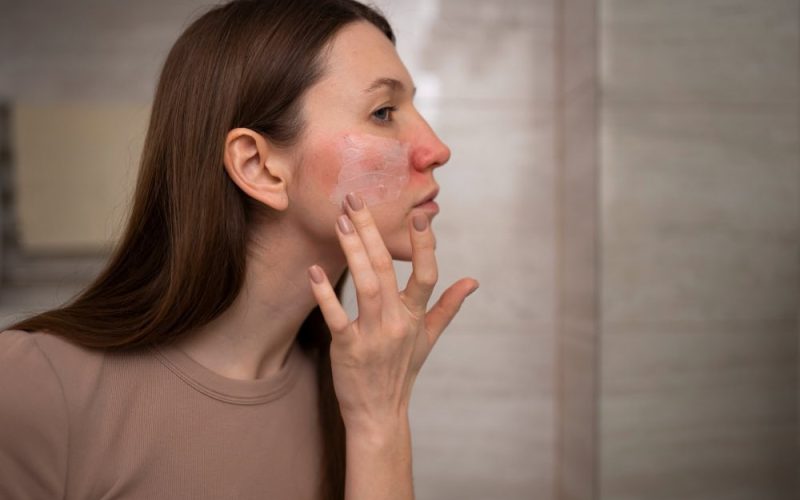 Rosacea