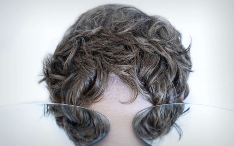 Should-I-Get-A-Hair-Transplant