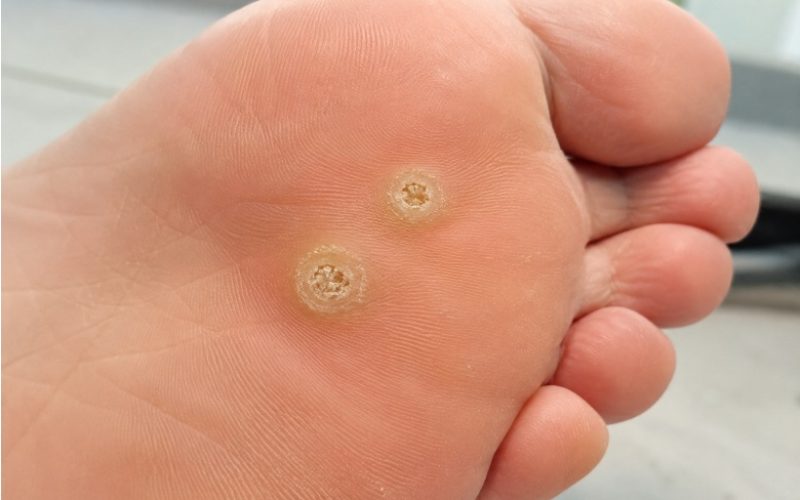 Signs your verucca is healing