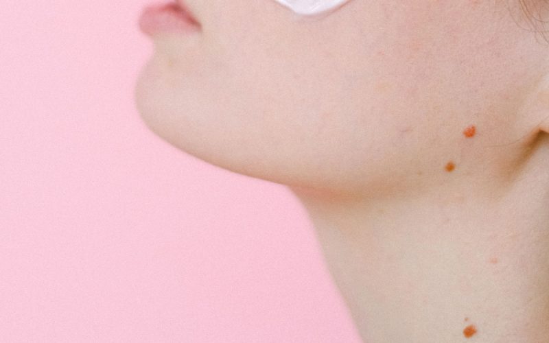 Skin-Tag-Causes-What-Is-a-Skin-Tag-Skin-Tags-Removal