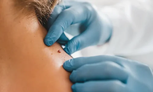 Skin Tag On Neck