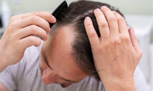 Steroid Hair Loss
